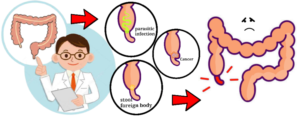 Read more about the article Appendicitis