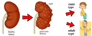 Read more about the article Polycystic Kidney Disease