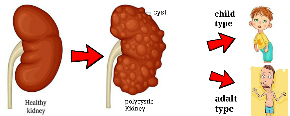 Read more about the article Polycystic Kidney Disease