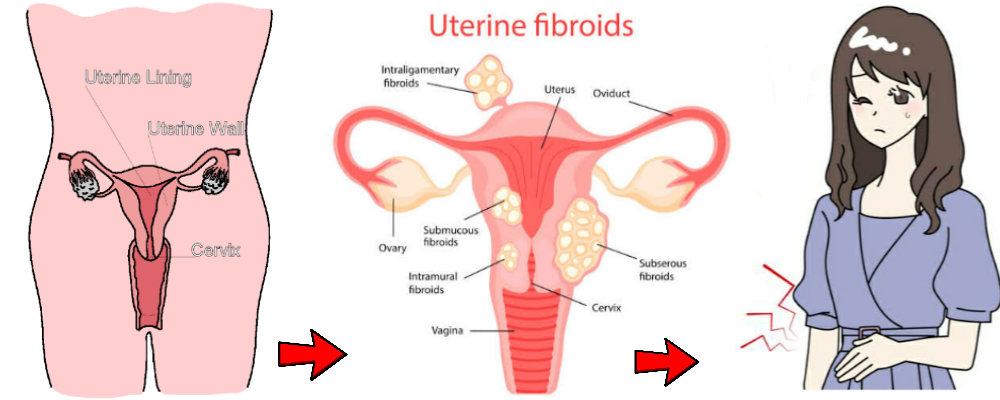 You are currently viewing UTERINE FIBROID