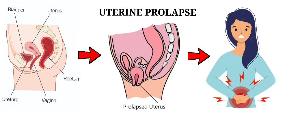 You are currently viewing UTERINE PROLAPSE