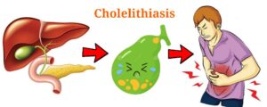 Read more about the article Cholelithiasis