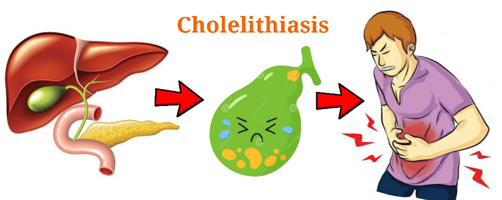 You are currently viewing Cholelithiasis