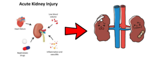 Read more about the article Acute Kidney Disease