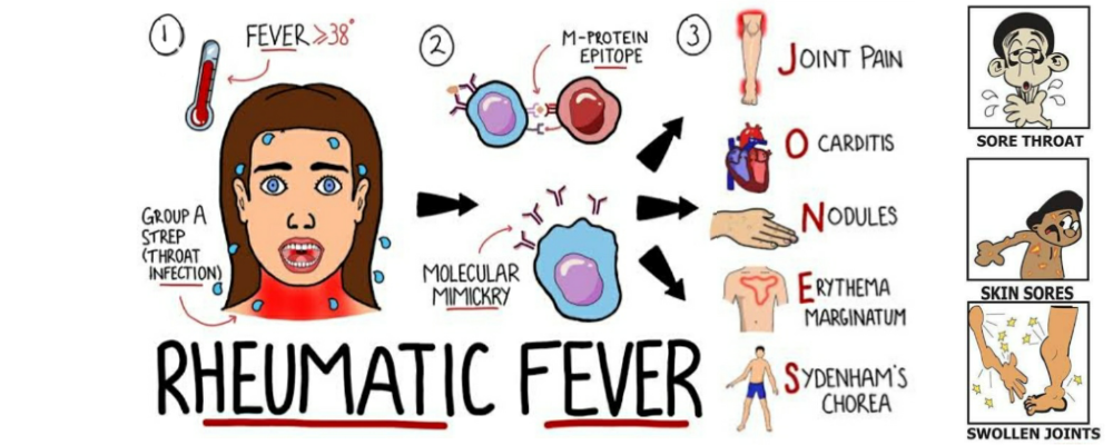 Read more about the article Acute rheumatic fever