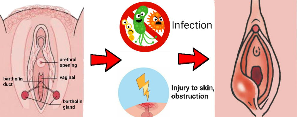 You are currently viewing Bartholin Cyst