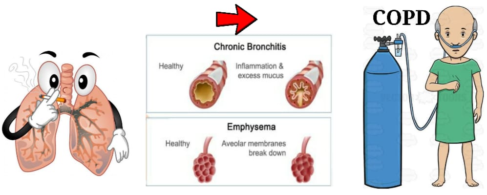 You are currently viewing COPD