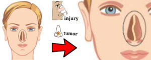 Read more about the article Deviated Nasal Septum (DNS)