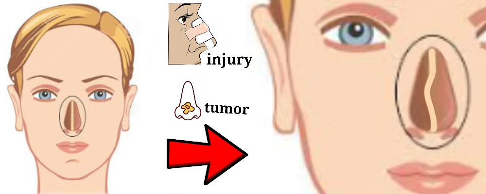 Read more about the article Deviated Nasal Septum (DNS)