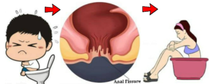 Read more about the article Fissure in ano