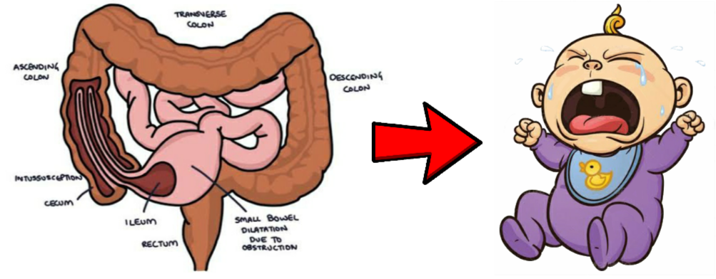 Read more about the article Intussusception