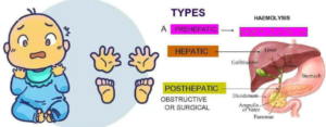 Read more about the article Jaundice