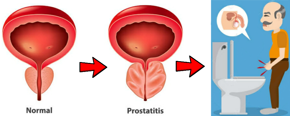 You are currently viewing Prostatitis