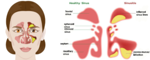 Read more about the article Sinusitis