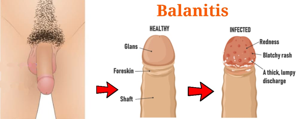 You are currently viewing BALANITIS