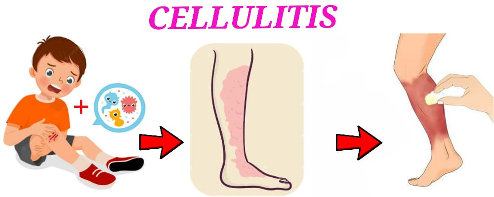 Read more about the article CELLULITIS