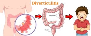 Read more about the article DIVERTICULITIS