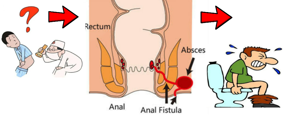 You are currently viewing Fistula in ano/ Anal fistula