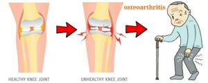 Read more about the article OSTEOARTHRITIS