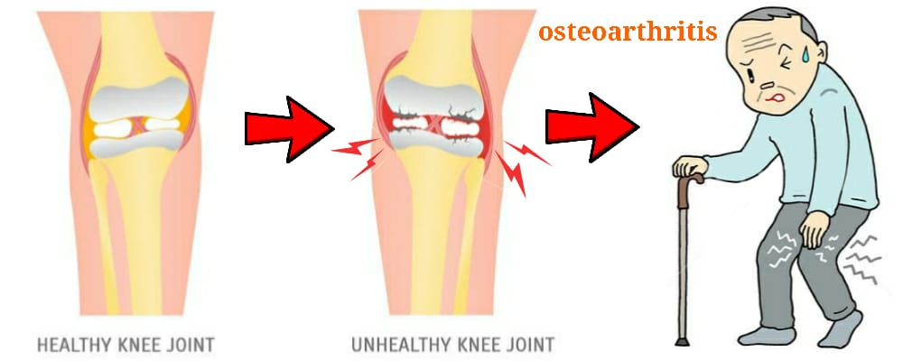 You are currently viewing OSTEOARTHRITIS