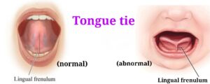 Read more about the article TONGUE-TIE / ANKYLOGLOSSIA