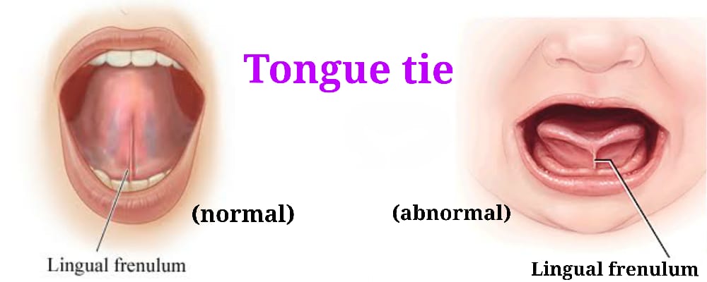 You are currently viewing TONGUE-TIE / ANKYLOGLOSSIA