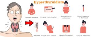 Read more about the article HYPERTHYROIDISM / THYROTOXICOSIS