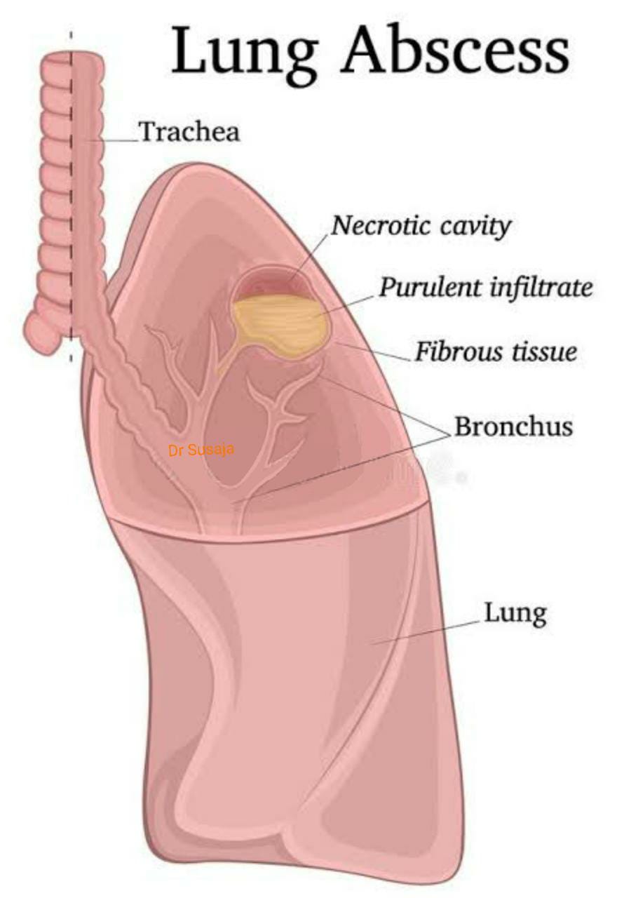 lung abscess