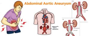 Read more about the article Abdominal Aortic Aneurysm